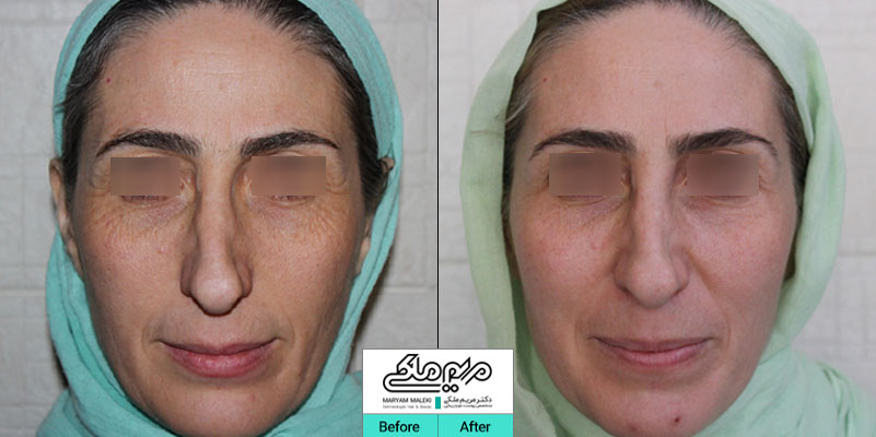بعد از یک جلسه تیکسل