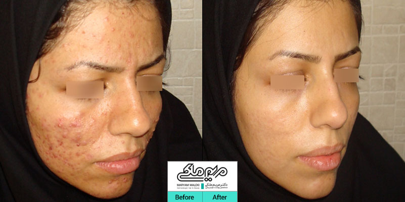بعد از یک جلسه آی پی ال