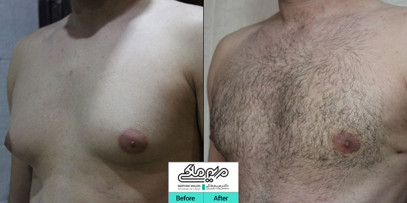 عمل ژنیکوماستی