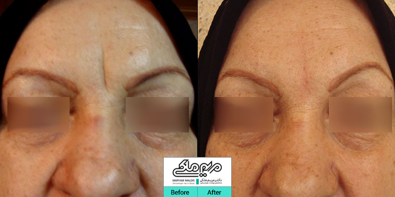 تزریق ژل در خط اخم