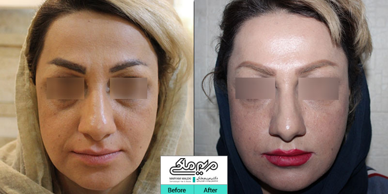 تزریق ژل در خط خنده