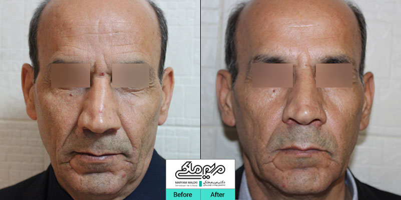 تزریق ژل در قسمت پایین صورت جهت جوانسازی