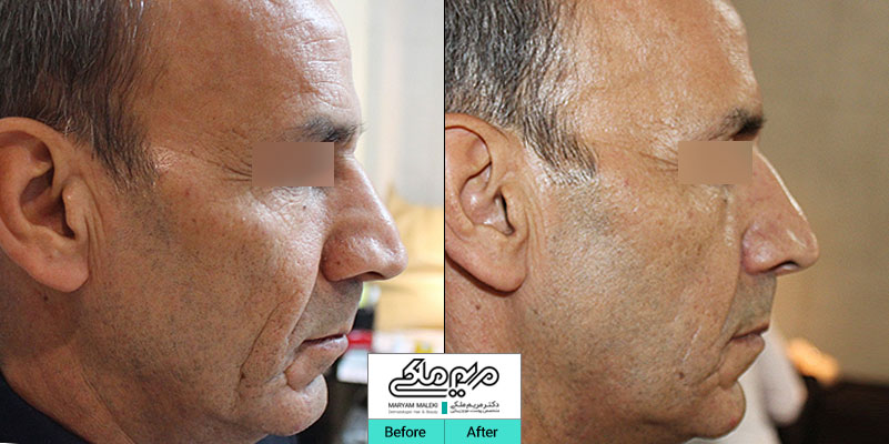 تزریق ژل در قسمت پایین صورت جهت جوانسازی