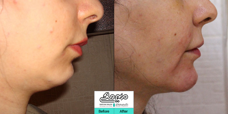 تزریق ژل در چانه