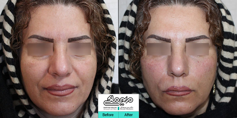 بلافاصله بعداز تزریق ژل خط خنده