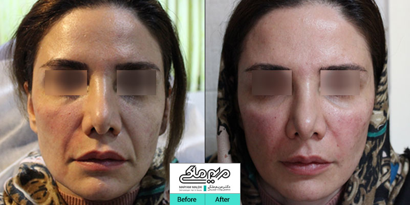 بلافاصله بعد از تزریق ژل خط خنده
