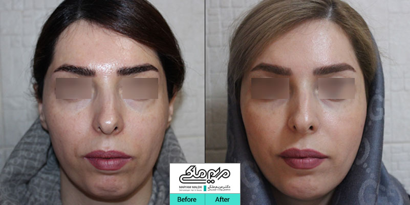 اصلاح فرم صورت با تزریق ژل