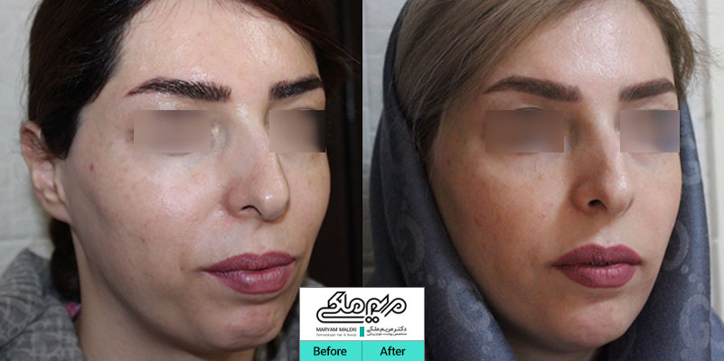 اصلاح فرم صورت با تزریق ژل