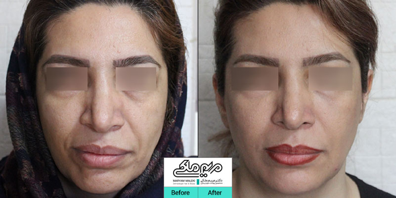 اصلاح فرم صورت و جوانسازی با تزریق ژل