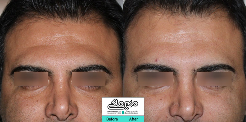 تزریق ژل در گودی پیشانی