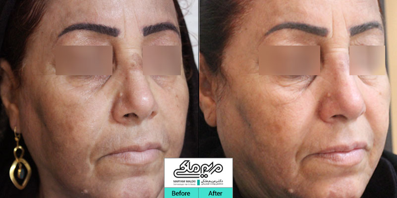 بعد از یک جلسه لیزر کیوسوئیچ و مزو تراپی صورت