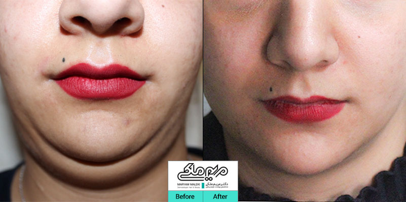 خارج نمودن چربی غبغب