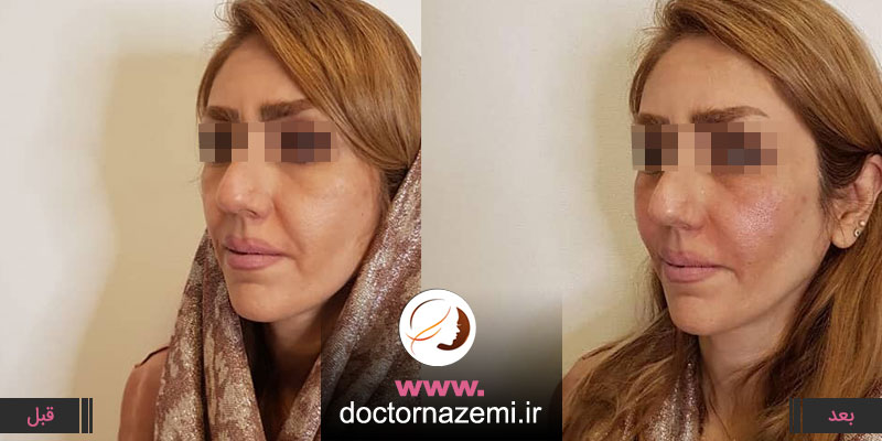 تزریق ژل در ناحیه خط خنده به میزان ۳ سی سی ، اصلاح فرم صورت و رفع خطوط خنده با تزریق ژل در یک جلسه