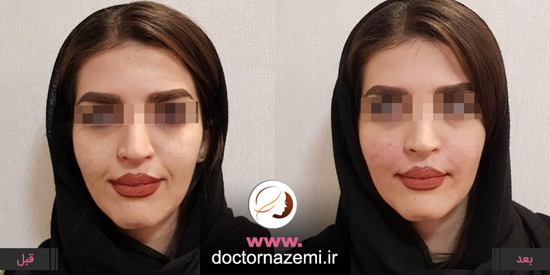 تزریق ژل در ناحیه خط خنده به میزان ۲ سی سی ، اصلاح فرم صورت و رفع خطوط خنده با تزریق ژل