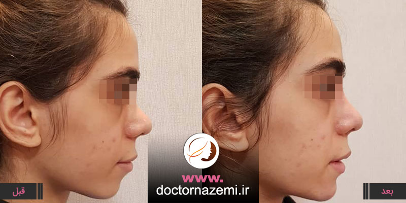 تزریق ژل در ناحیه چانه به میزان ۲سی سی ، رفع نواقص چانه ایشان در یک جلسه مراجعه با تزریق ژل و بهبود فرم صورت