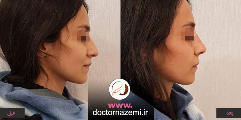 اصلاح بدفرمیهای صورت با تزریق ۱سی سی ژل در بینی ، رفع نواقص بینی و بالا آوردن نوک بینی بوسیله تزریق ژل