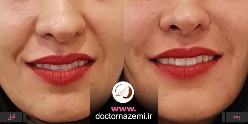 اصلاح فرم صورت و رفع خطوط خنده و  خط اندوه با تزریق ۱ سی سی ژل در یک جلسه