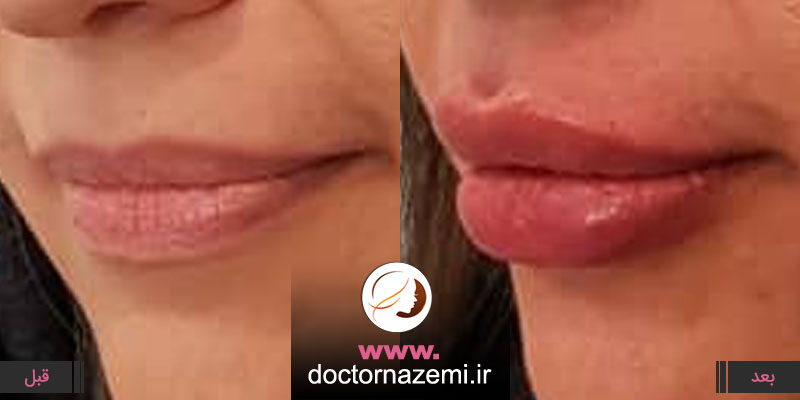 حجم دهی به لب و تزریق ژل در ناحیه خط لب مدل روسی