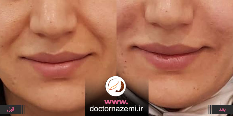 تزریق ۲ سی سی ژل در خط خنده ، اصلاح فرم صورت و رفع خطوط خنده با تزریق ۲ سی سی ژل در یک جلسه