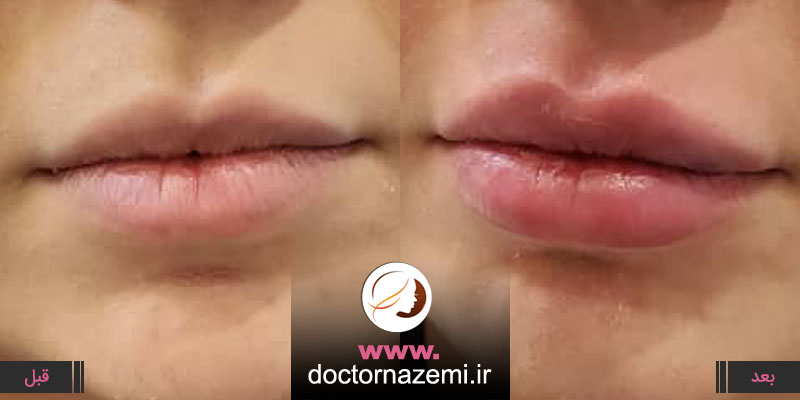 تزریق ژل به لب در یک جلسه برای فرم دهی