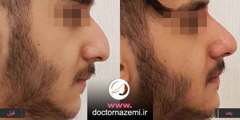 اصلاح بدفرمیهای صورت تزریق ۱سی سی ژل در بینی رفع نواقص بینی و بالا آوردن نوک بینی بوسیله تزریق ژل