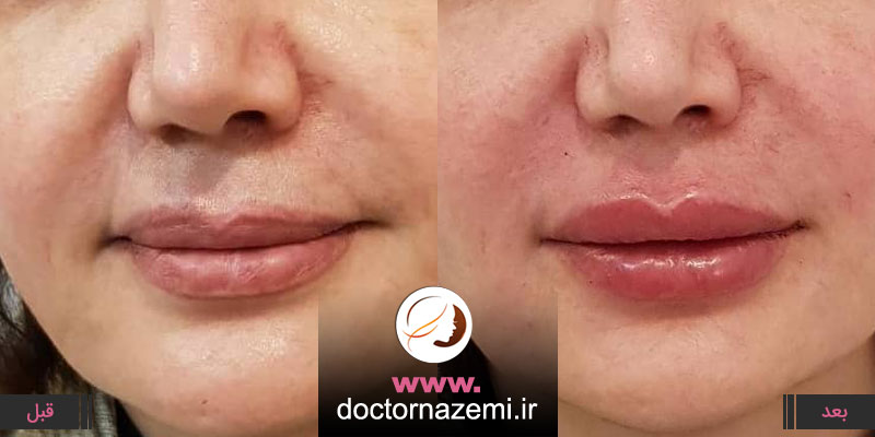 حجم دهی به لب و تزریق ژل در ناحیه خط لب تزریق ژل به میزان یک سی سی به لب