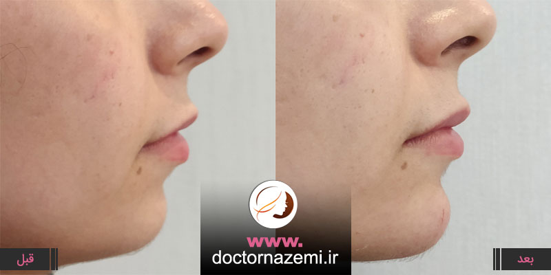 تزریق ژل در ناحیه چانه جهت زیبایی و بهتر شدن فرم ظاهری چانه