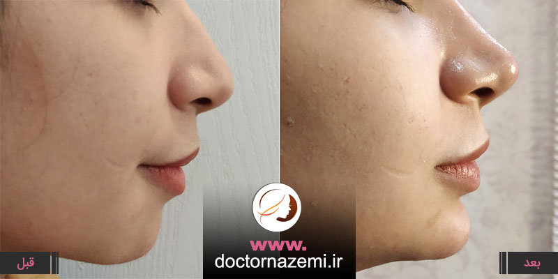 اصلاح عقب رفتگی چانه با تزریق ژل چانه