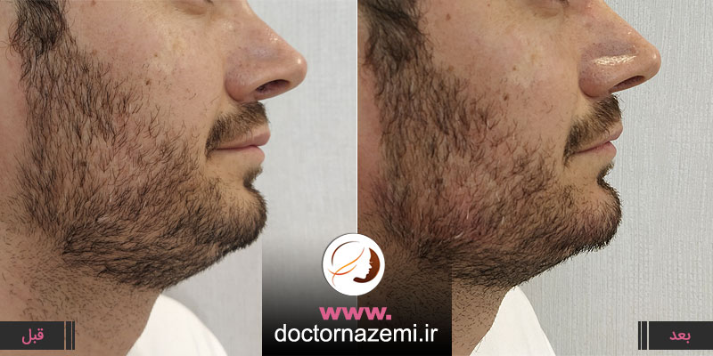 تزریق ژل و فیلر جهت زاویه سازی فک و اصلاح فرم چانه