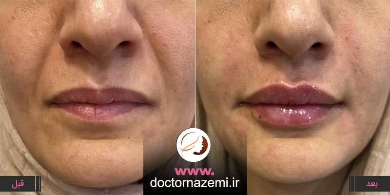 تزریق فیلر جهت برجسته سازی لب و رفع خط خنده
