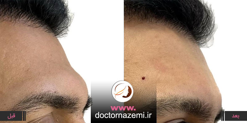 تزریق فیلر برای رفع گودی، تورفتگی و خطوط پیشانی