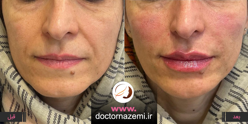 زاویه سازی، کانتور و اصلاح فرم نیمه پایین صورت