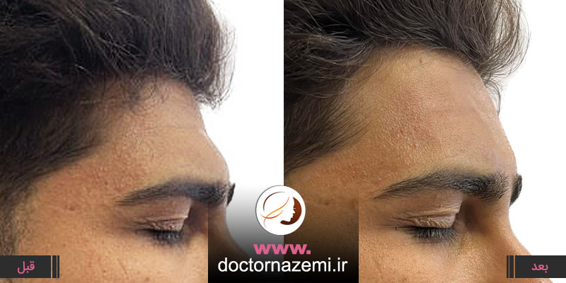 رفع گودی پیشانی و ورم بالای ابرو با تزریق فیلر