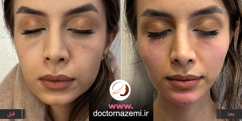 اصلاح فرم چانه و حجم دهی گونه با تزریق فیلر