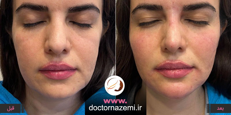 تزریق ژل در ناحیه گونه و چانه در یک جلسه