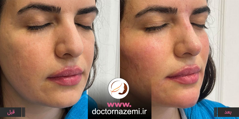 تزریق ژل گونه و چانه همزمان در یک جلسه