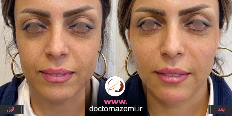 عکس قبل و بعد تزریق ژل خط خنده، گونه و زیر چشم