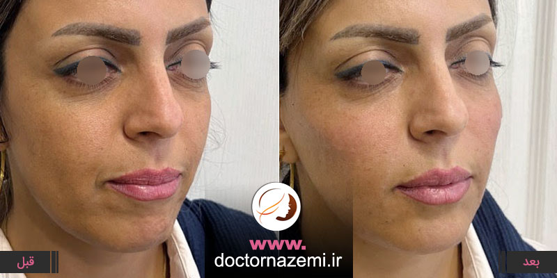 تزریق فیلر کانتورینگ صورت، خط خنده و گونه در اصفهان