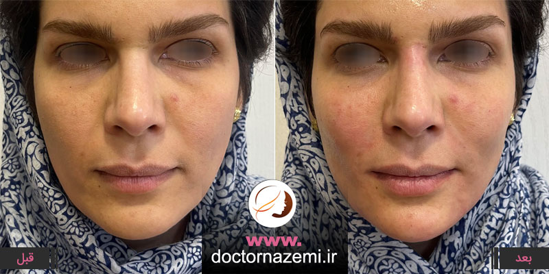 تزریق همزمان فیلر خط خنده، گونه و بینی در یک جلسه