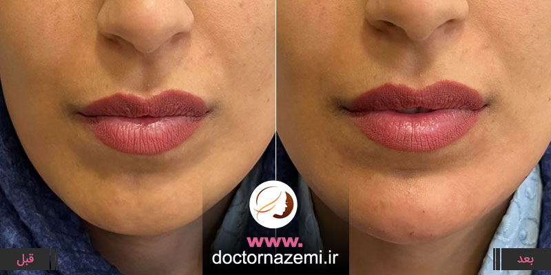 تزریق فیلر برای قرینه سازی فک و چانه