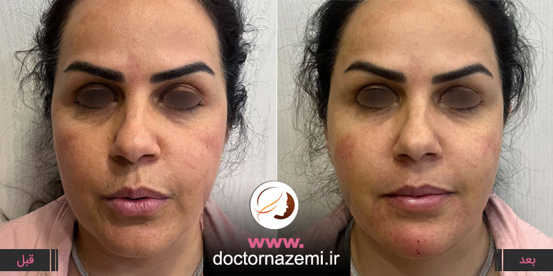 عکس قبل و بلافاصله بعد تزریق فیلر چانه ، گونه و شقیقه
