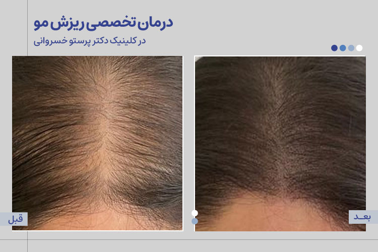 درمان تخصصی ریزش مو 