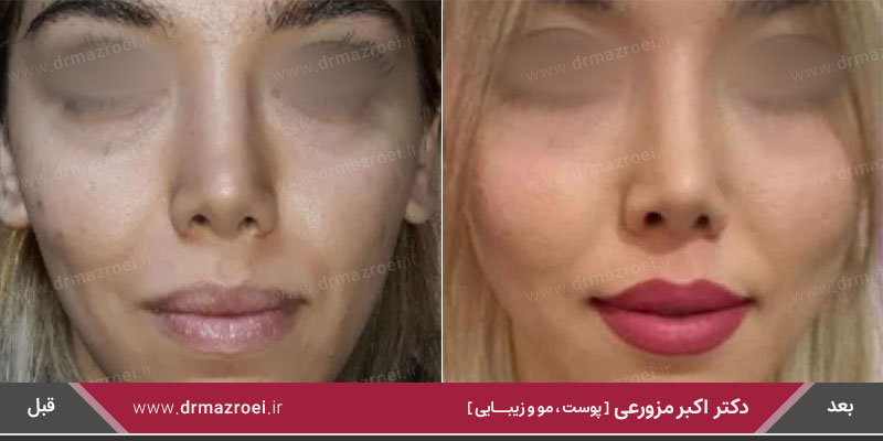 تزریق ژل گونه 