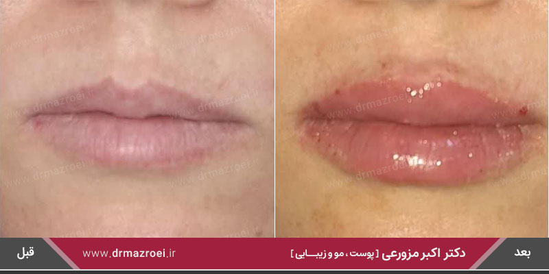 تزریق ژل لب در اصفهان 
