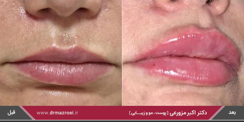 تزریق ژل لب 