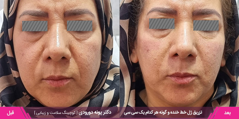 نمونه کار تزریق ژل خط خنده و گونه هر کدام یک سی سی 