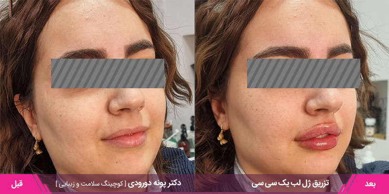 نمونه کار تزریق ژل لب یک سی سی 