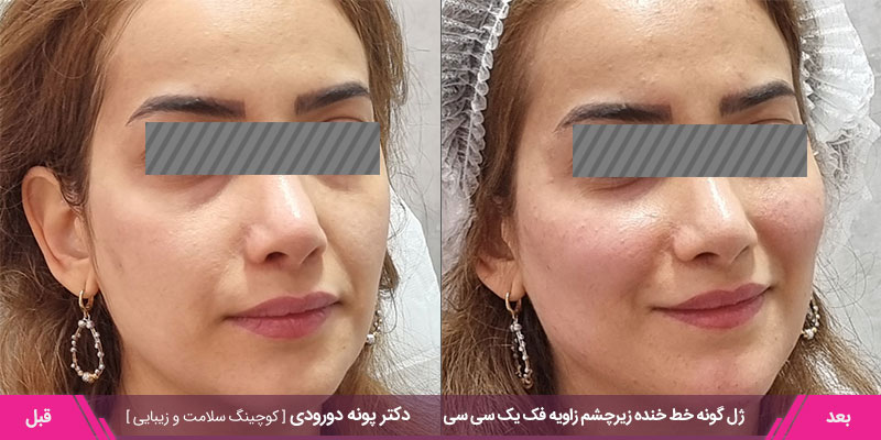 نمونه کار تزریق ژل گونه یک سی سی  