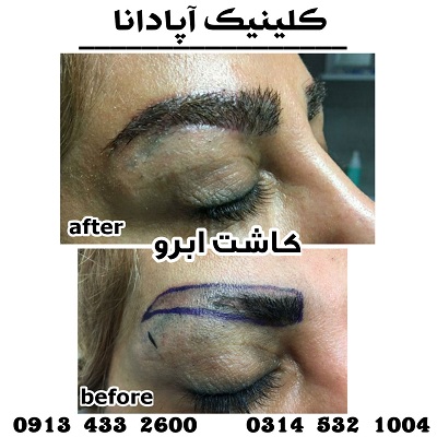 کاشت ابرو