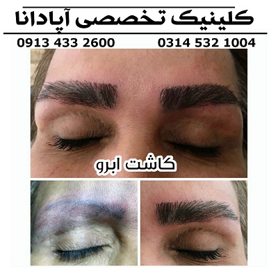 کاشت ابرو